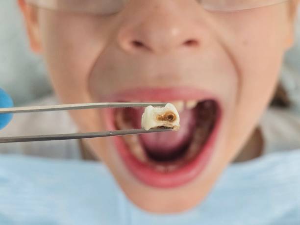 Best Emergency Dental Care for Broken or Chipped Teeth in Biltmore Forest, NC